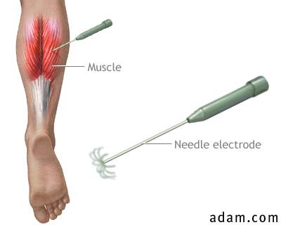 does painful emg test indicatr nerve damage